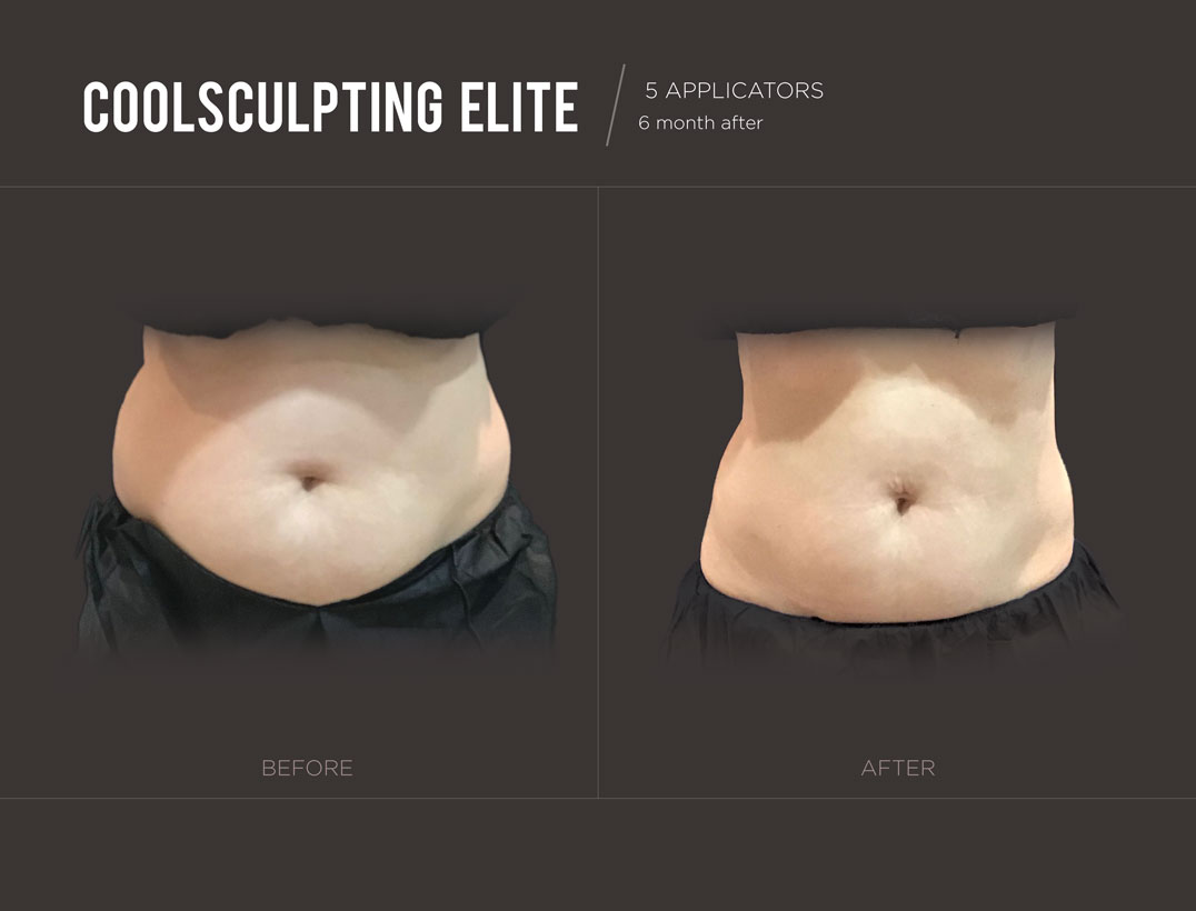 coolsculpting-results-woman-new-york