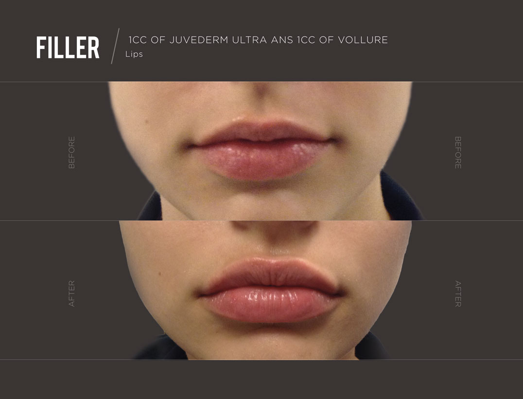 lip-filler-before-after-results-trifectamedspa-newyork